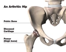 An Arthritic Hip